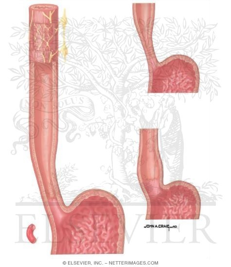 Lower Esophageal Sphincter and Refulx Prevention