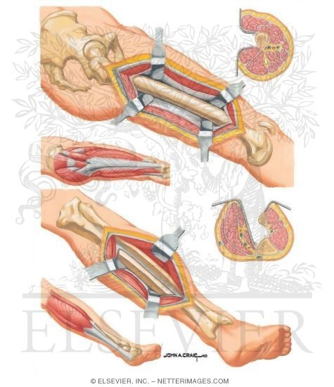 Watermarked preview of unlabeled image: Surgical Approaches to the Thigh and Hip