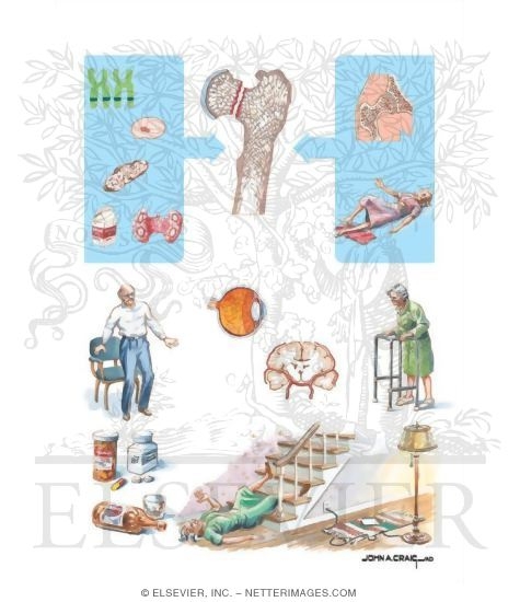 Watermarked preview of unlabeled image: Risk Factors for Fractures