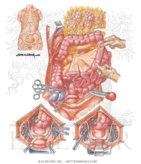 Staging Laparotomy