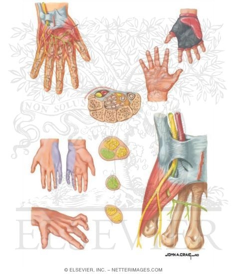 Watermarked preview of unlabeled image: Ulnar Tunnel Syndrome