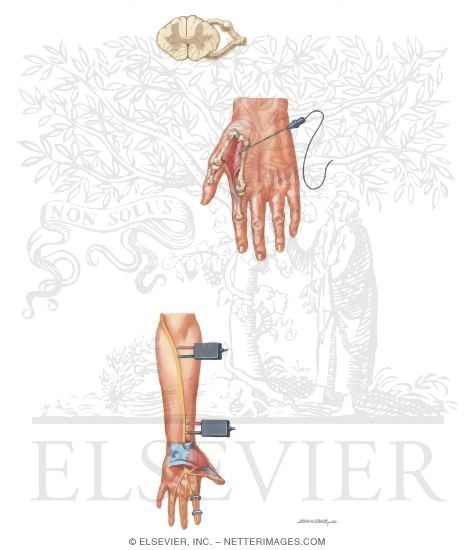 Electrodiagnostic Studies in Compression Neuropathy
