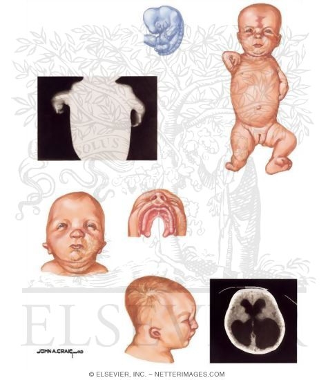 Watermarked preview of unlabeled image: Drug-Induced Embryopathies