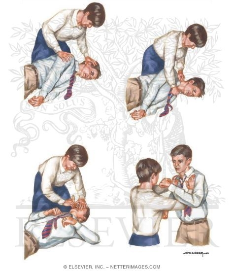 Watermarked preview of unlabeled image: Acute Management of Tonic Clonic Seizure