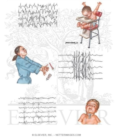 Epilepsy Syndromes
