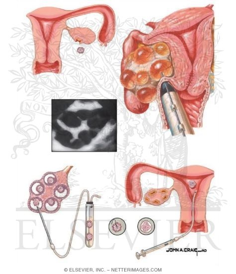 Watermarked preview of unlabeled image: In Vitro Fertilization