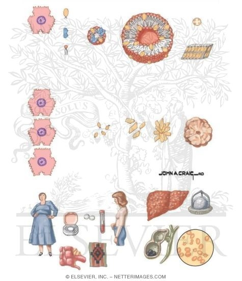 Pathogensis of Gallstones