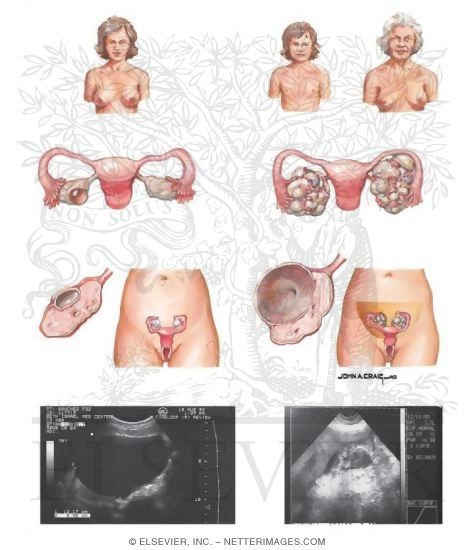 Watermarked preview of unlabeled image: Clinical Evaluation of Ovarian Mass