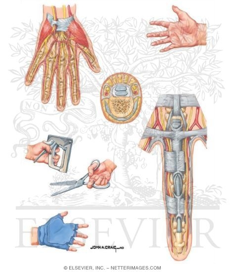 Digital Nerve Compression