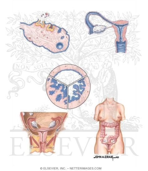 Watermarked preview of unlabeled image: Epithelial Ovarian Cancer