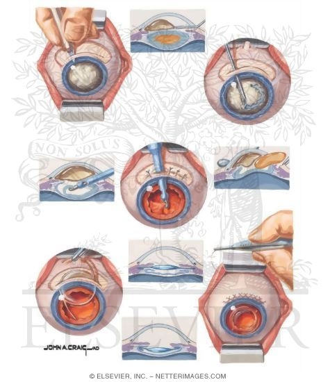 Extracapsular Extraction and Insertion of IOL