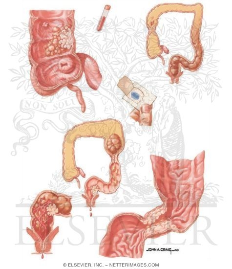Watermarked preview of unlabeled image: Clinical Manifestations of Colorectal Cancer