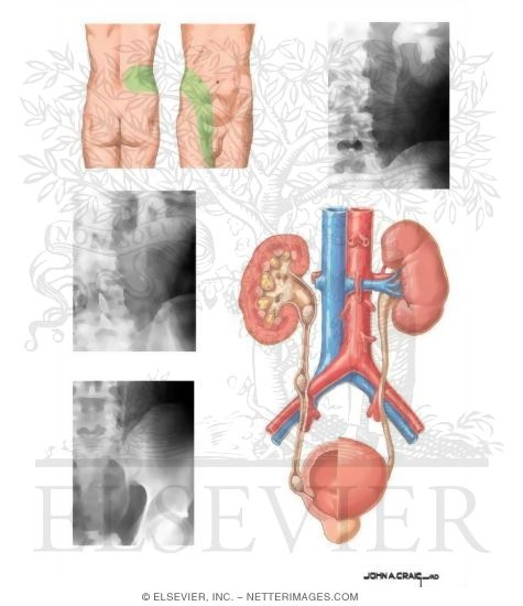 Watermarked preview of unlabeled image: Calculous Urinary Obstruction