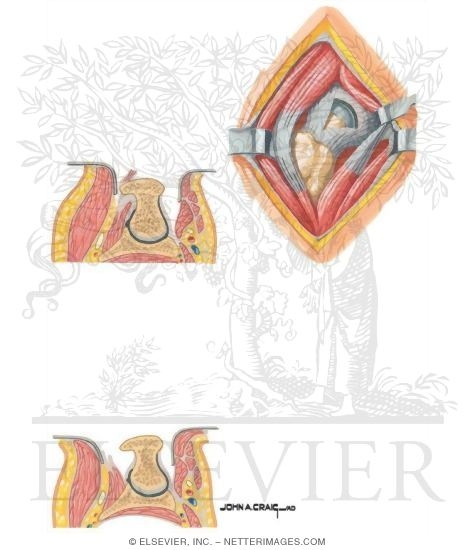 Watermarked preview of unlabeled image: Surgical Approaches to the Thigh and Hip