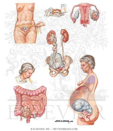 Watermarked preview of unlabeled image: Signs and Symptoms of Ovarian Cancer