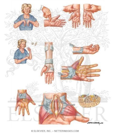 Watermarked preview of unlabeled image: Carpal Tunnel Syndrome