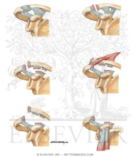 Stages of Acromioclavicular Dislocation