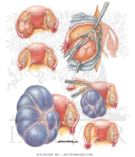 Watermarked preview of unlabeled image: Surgical Options for Pelvic Mass