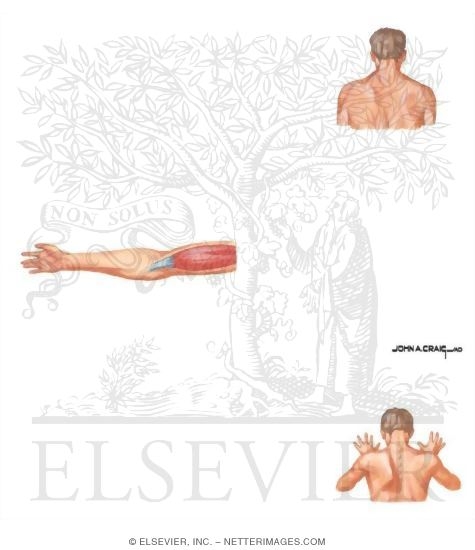 Watermarked preview of unlabeled image: Neuropathy About Shouder