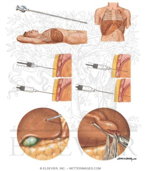 Liver Biopsy