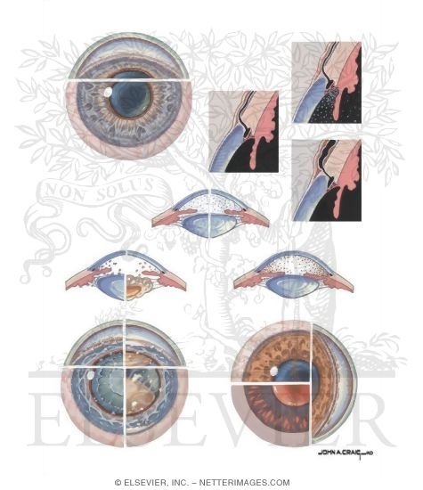 Watermarked preview of unlabeled image: Open Angle Glaucoma