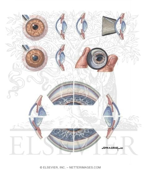 Assessment of Anterior Chamber Depth