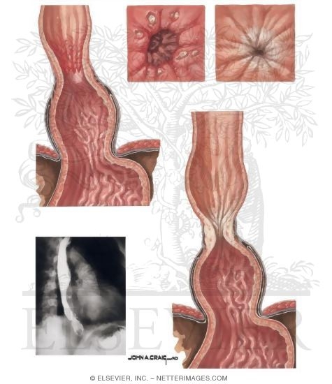 эозинофильный эзофагит рекомендации