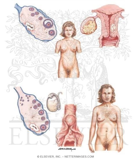 Stromal (Sex Cord) Ovarian Tumor
Granulosa Cell Tumors
