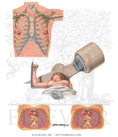 Watermarked preview of unlabeled image: Radiation Therapy