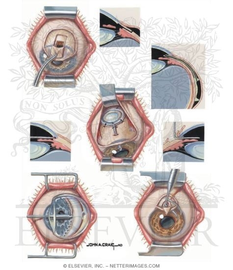 Watermarked preview of unlabeled image: Surgical Management