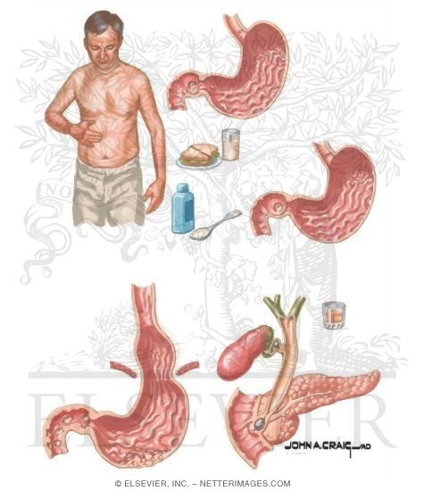 Watermarked preview of unlabeled image: Peptic Ulcer Symptoms and Differential Diagnosis