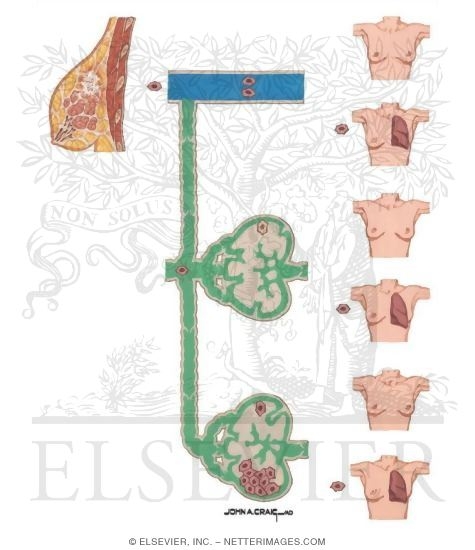 Watermarked preview of unlabeled image: Pathways of Tumor Dissemination