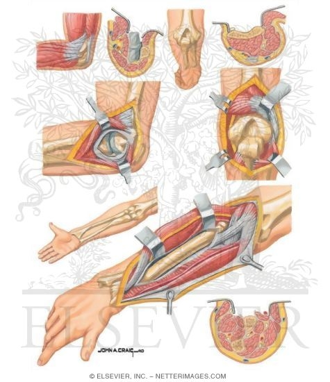 Watermarked preview of unlabeled image: Surgical Approaches to the Elbow