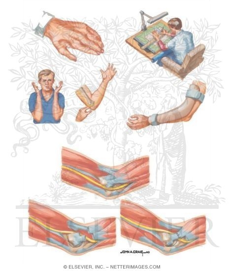 Watermarked preview of unlabeled image: Cubital Tunnel Syndrome
