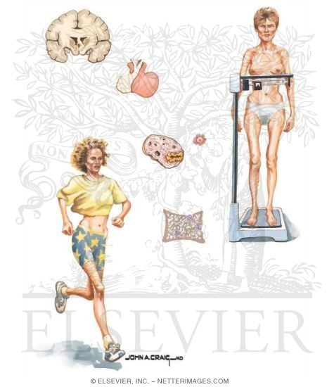 Osteoporosis Associated with Amenorrhea