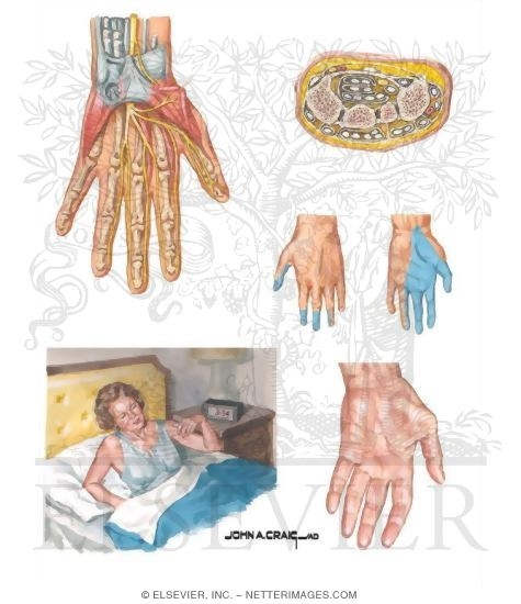 Carpal Tunnel Syndrome