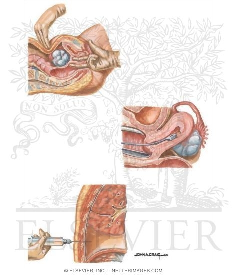 Watermarked preview of unlabeled image: Preoperative Evaluation of Pelvic Mass