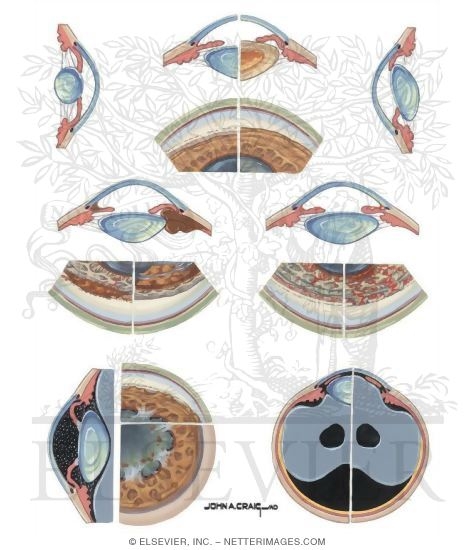 Secondary Closed Angle Glaucoma