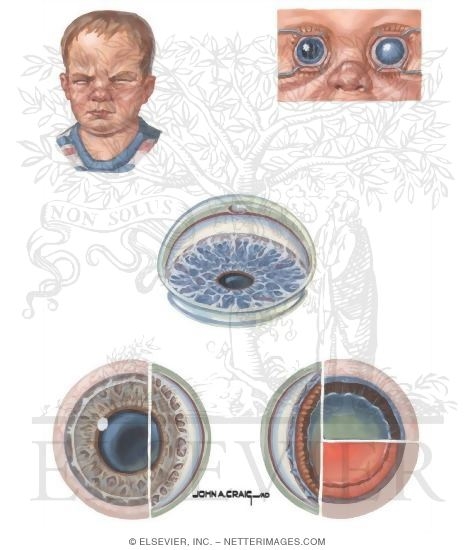 Developmental Glaucoma