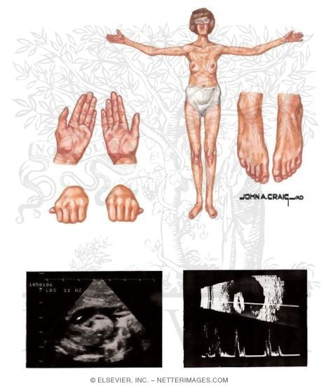 Marfan Syndrome