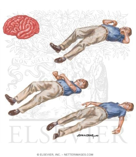Generalized Tonic Clonic Seizures