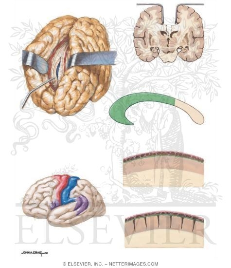 Watermarked preview of unlabeled image: Disconnective Surgery