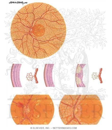 Panretinal Photocoagulation