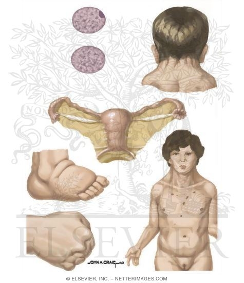 Turner (XO) Syndrome