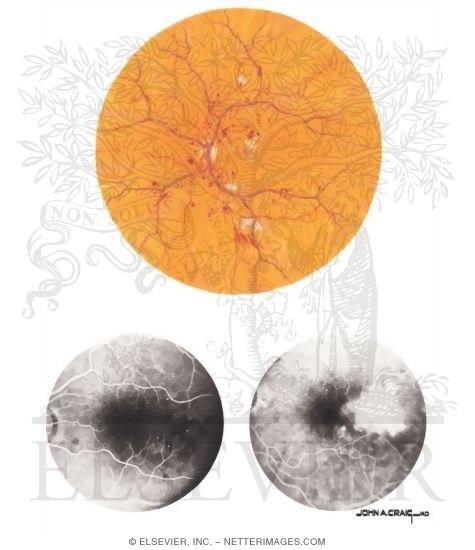 Watermarked preview of unlabeled image: Diabetic Retinopathy