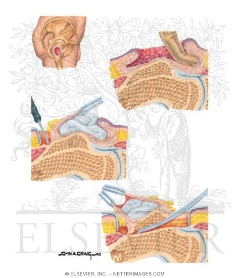 Watermarked preview of unlabeled image: Excision of Trochanteric Pressure Ulcer