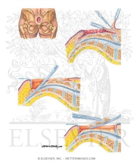 Watermarked preview of unlabeled image: Excision for Darcal Pressure Ulcer