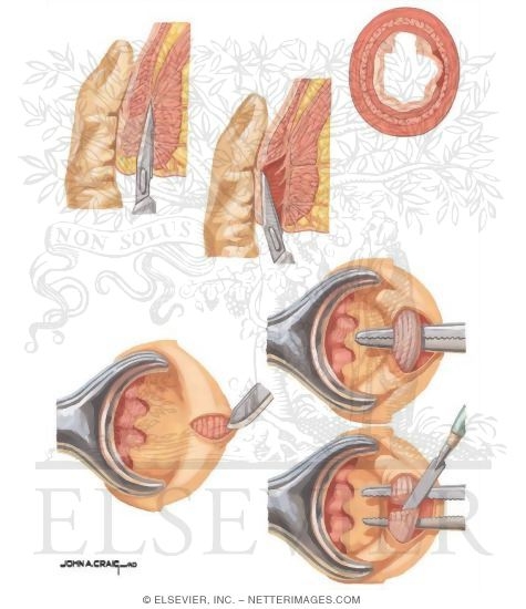 Lateral Internal Sphincterotomy 