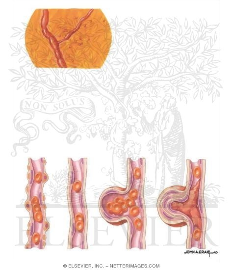 Microaneurysms