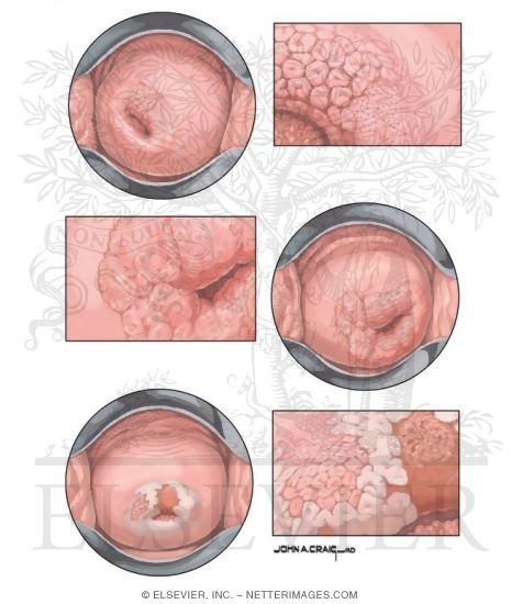 Colposcopic Views of Abnormal Cervical Changes
Carcinoma in Situ (Cervix)
